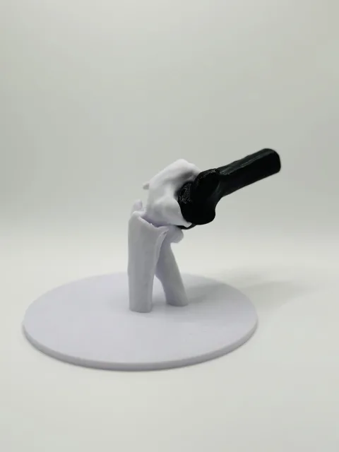 Olecanon und Radiusköpfchen Fraktur 3D Modell