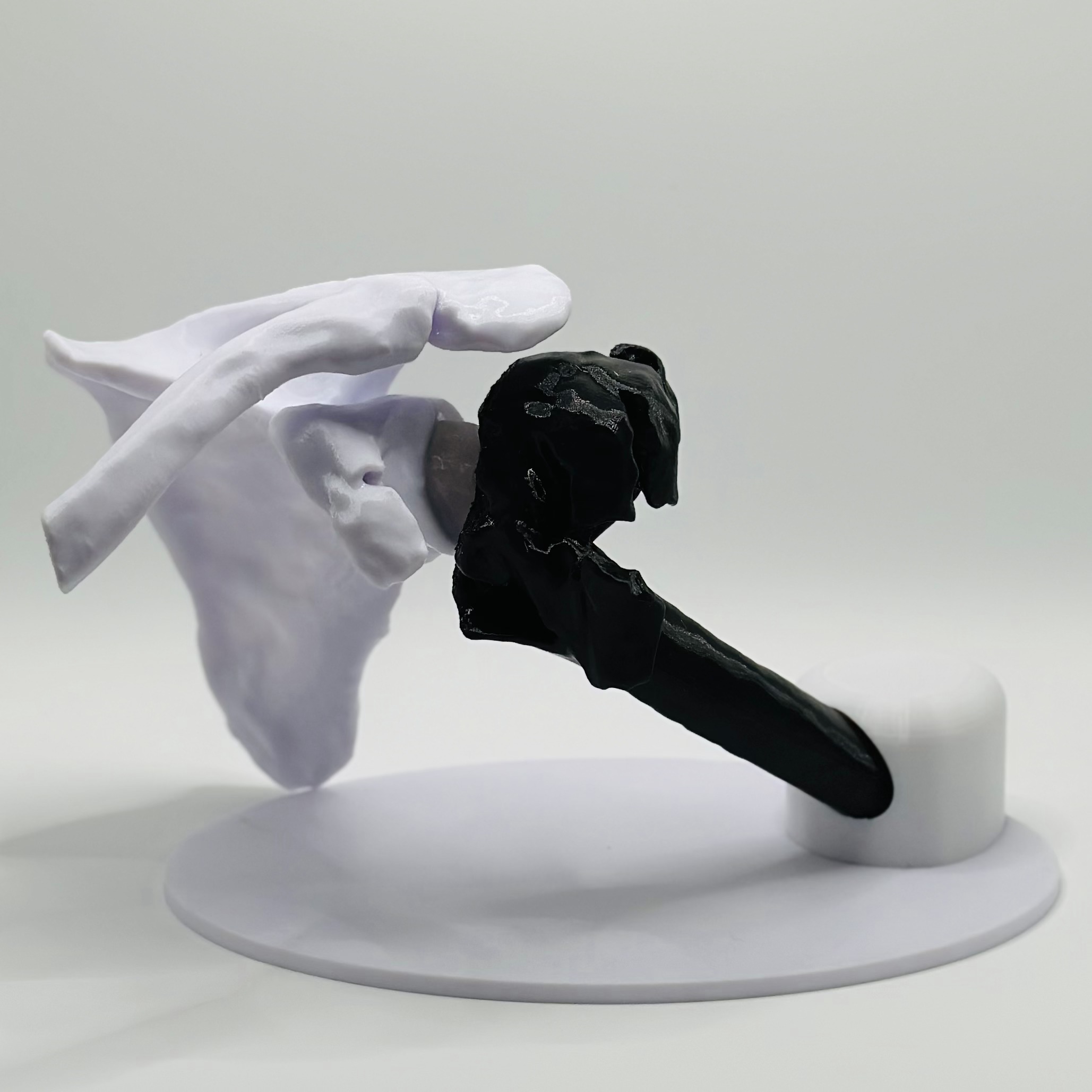 Humeral head fracture 3D model