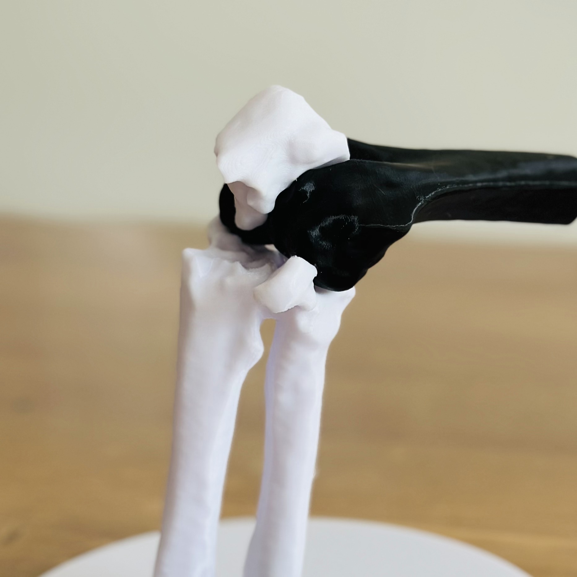 Olecanon Fracture 3D Model