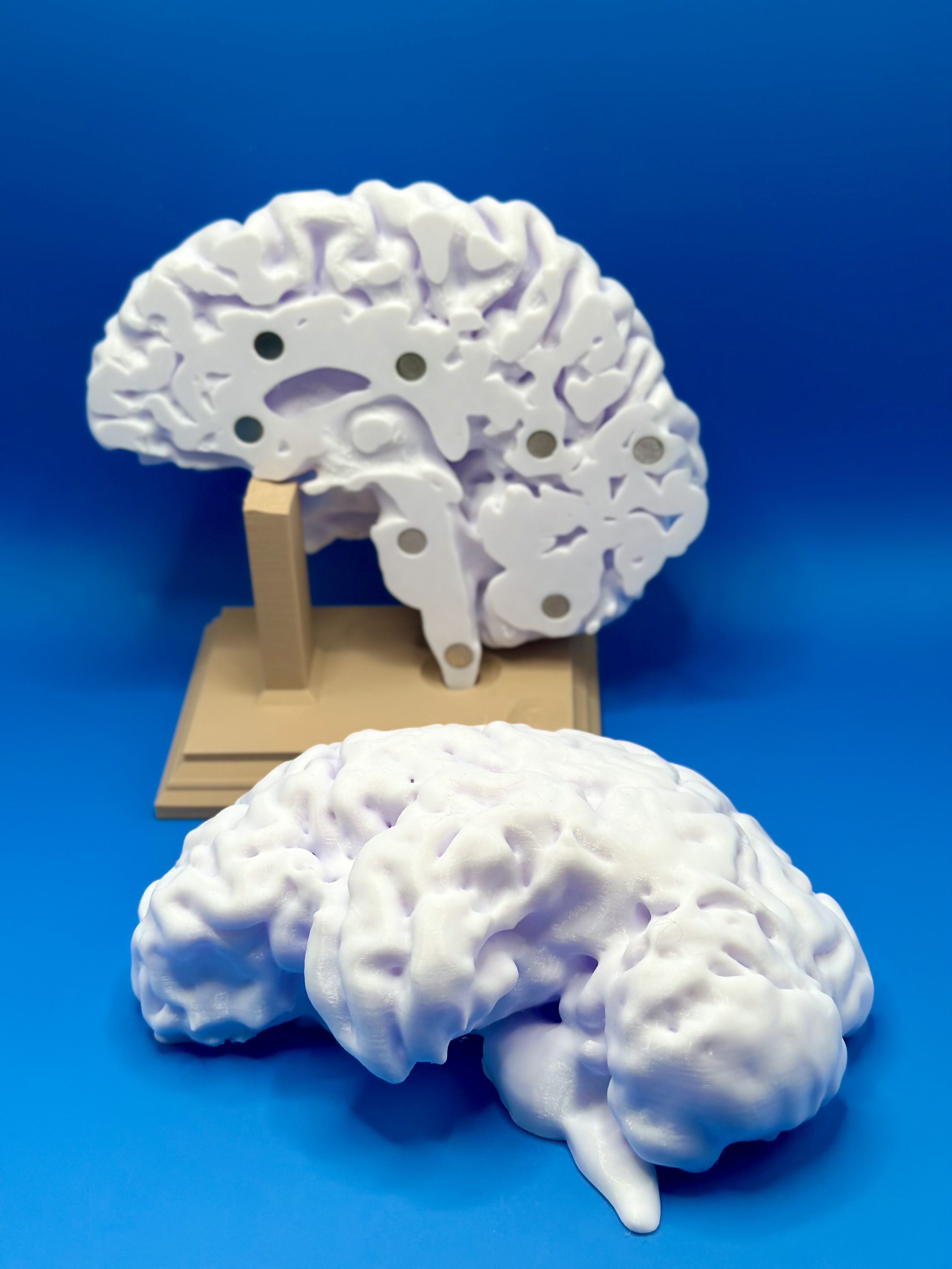 Olecanon and radial head fracture 3D model