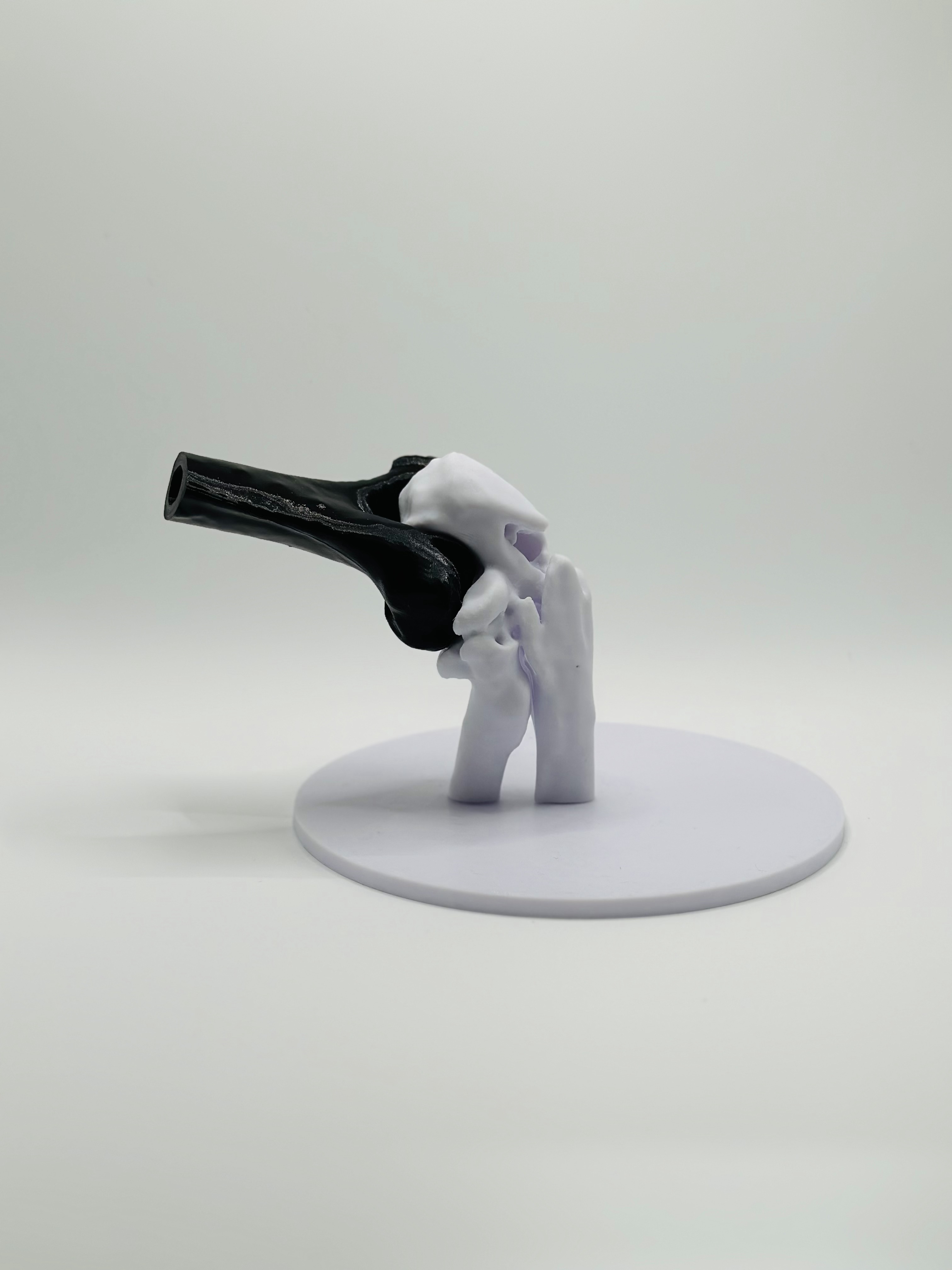 Olecanon and radial head fracture 3D model