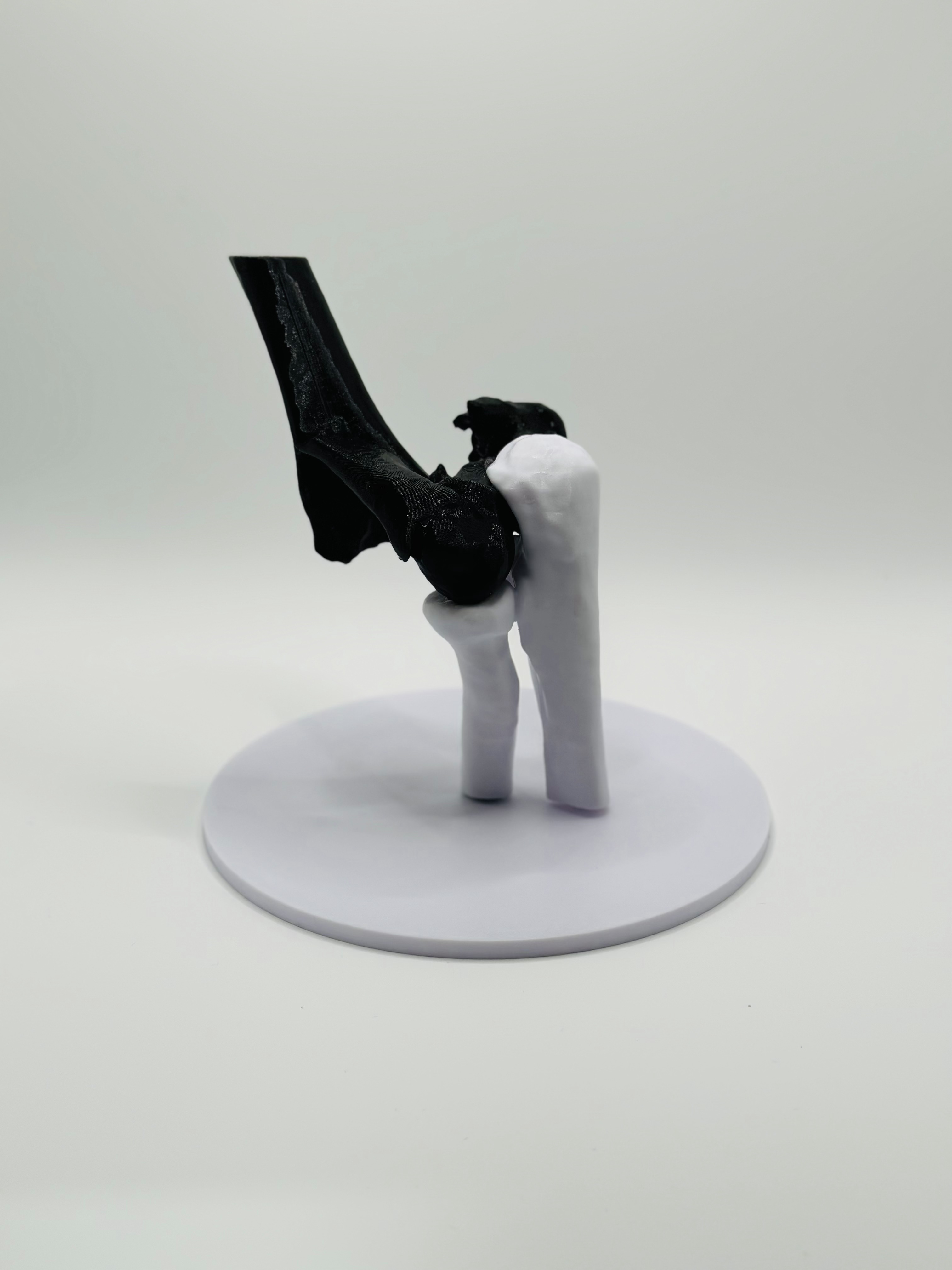 Humerus fracture 3D model