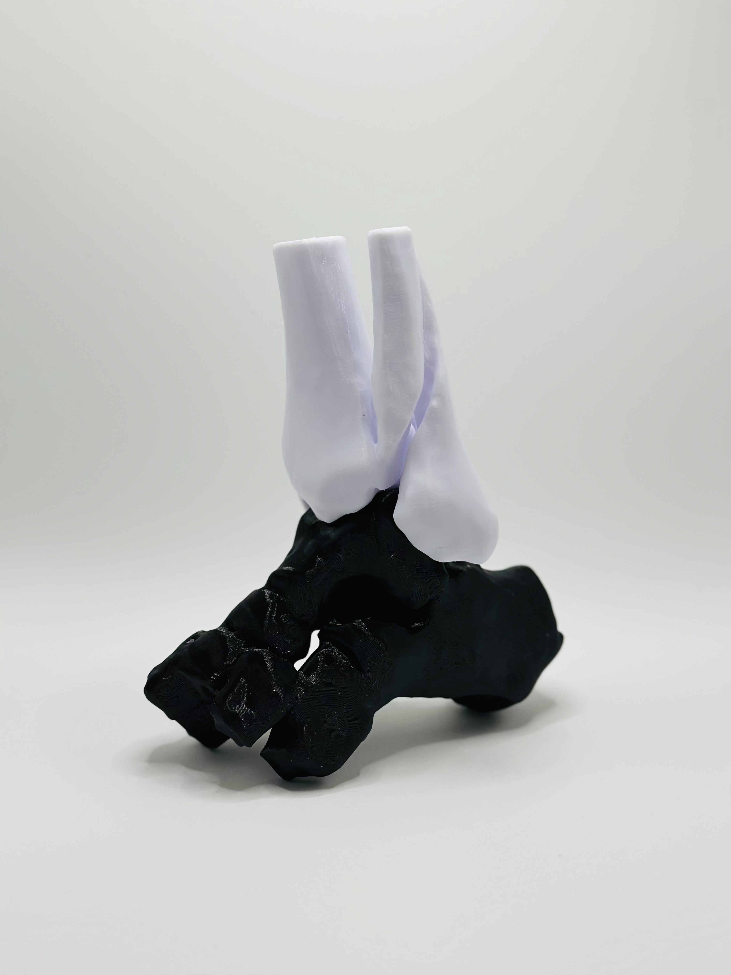 Weber C Fracture 3D model
