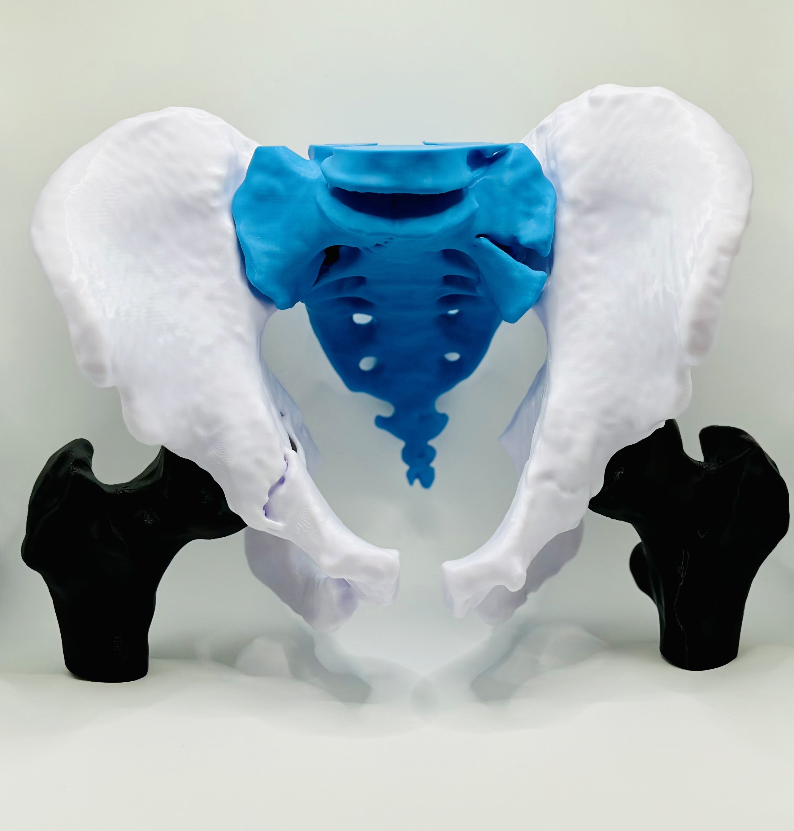 Pelvic fracture 3D model